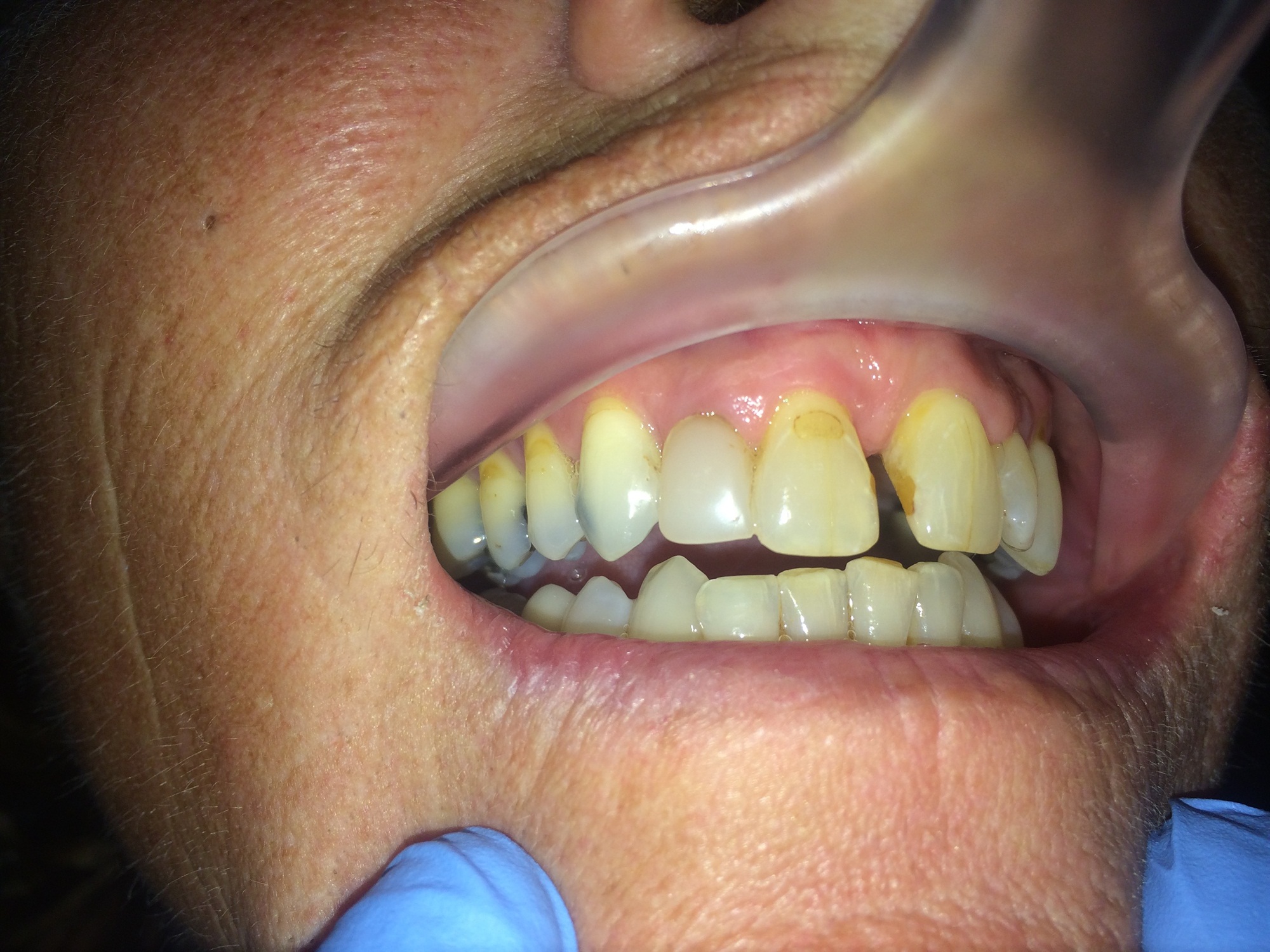 Completed post and core restoration with Dentapreg PINPost, clinical view.