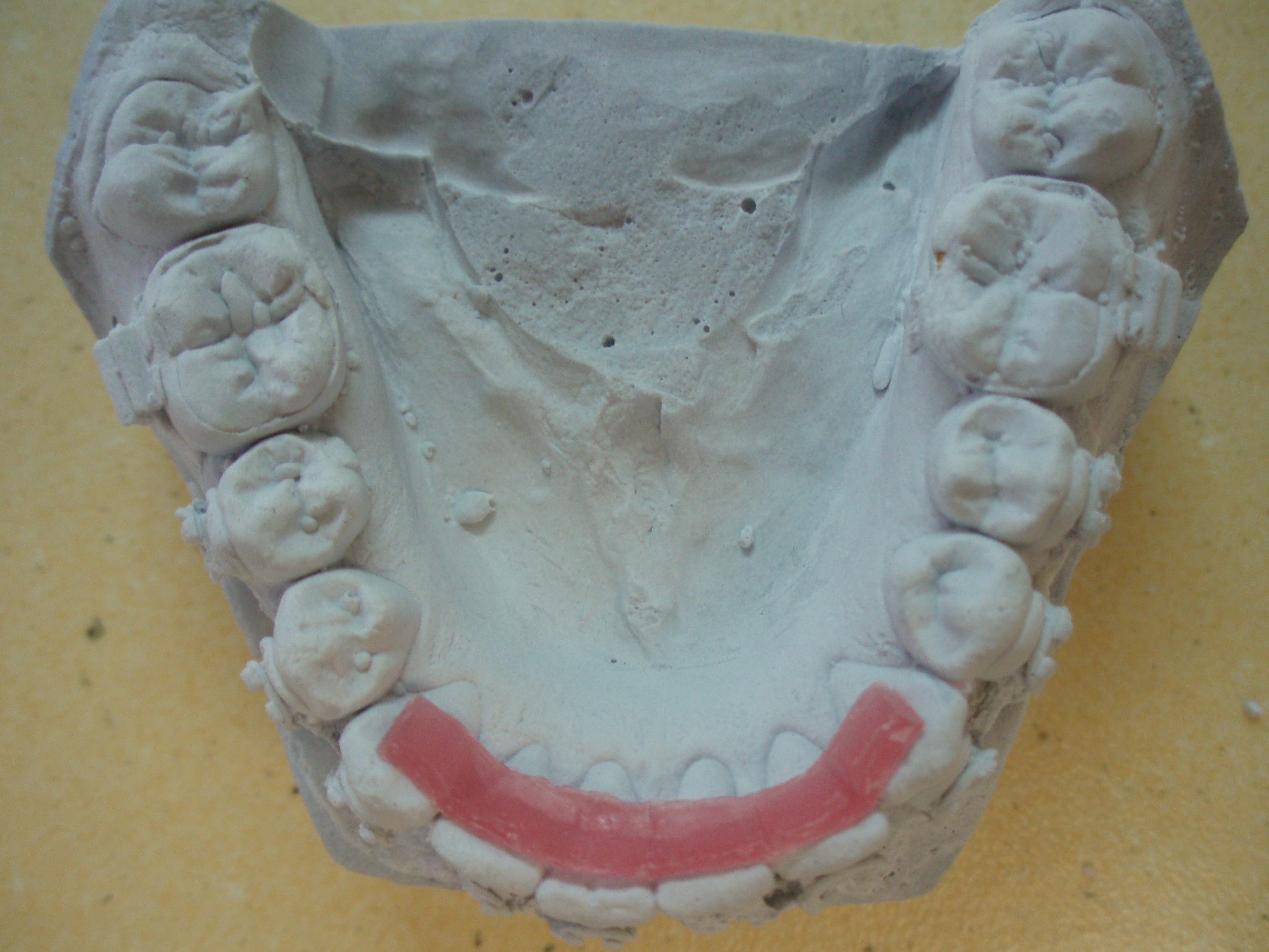 Initial placement for post-ortho retention with Dentapreg SFM by Dr. Fillipi.