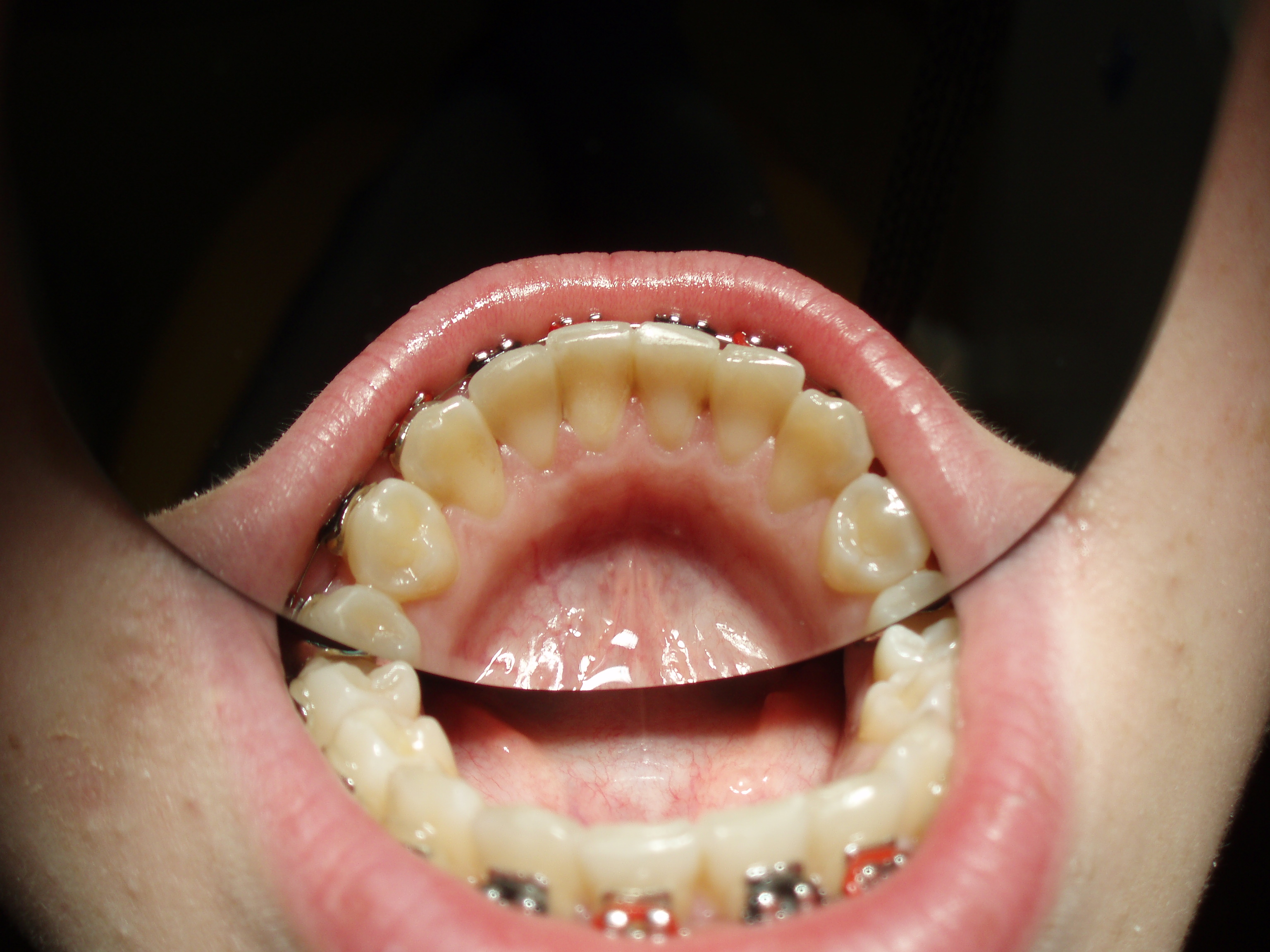 Alignment step of post-ortho retention with Dentapreg SFM by Dr. Fillipi.
