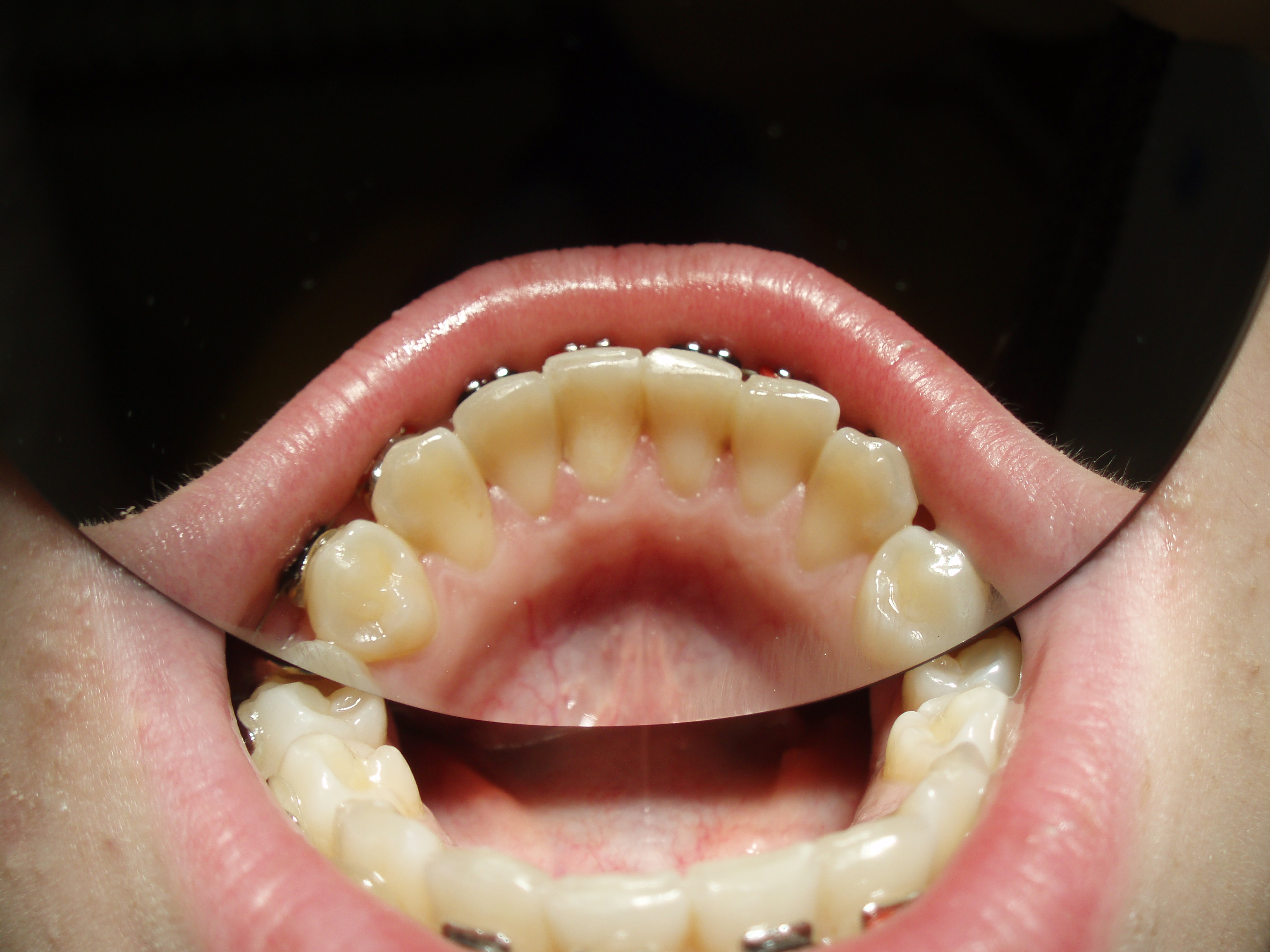 Completed post-ortho retention with Dentapreg SFM by Dr. Fillipi.