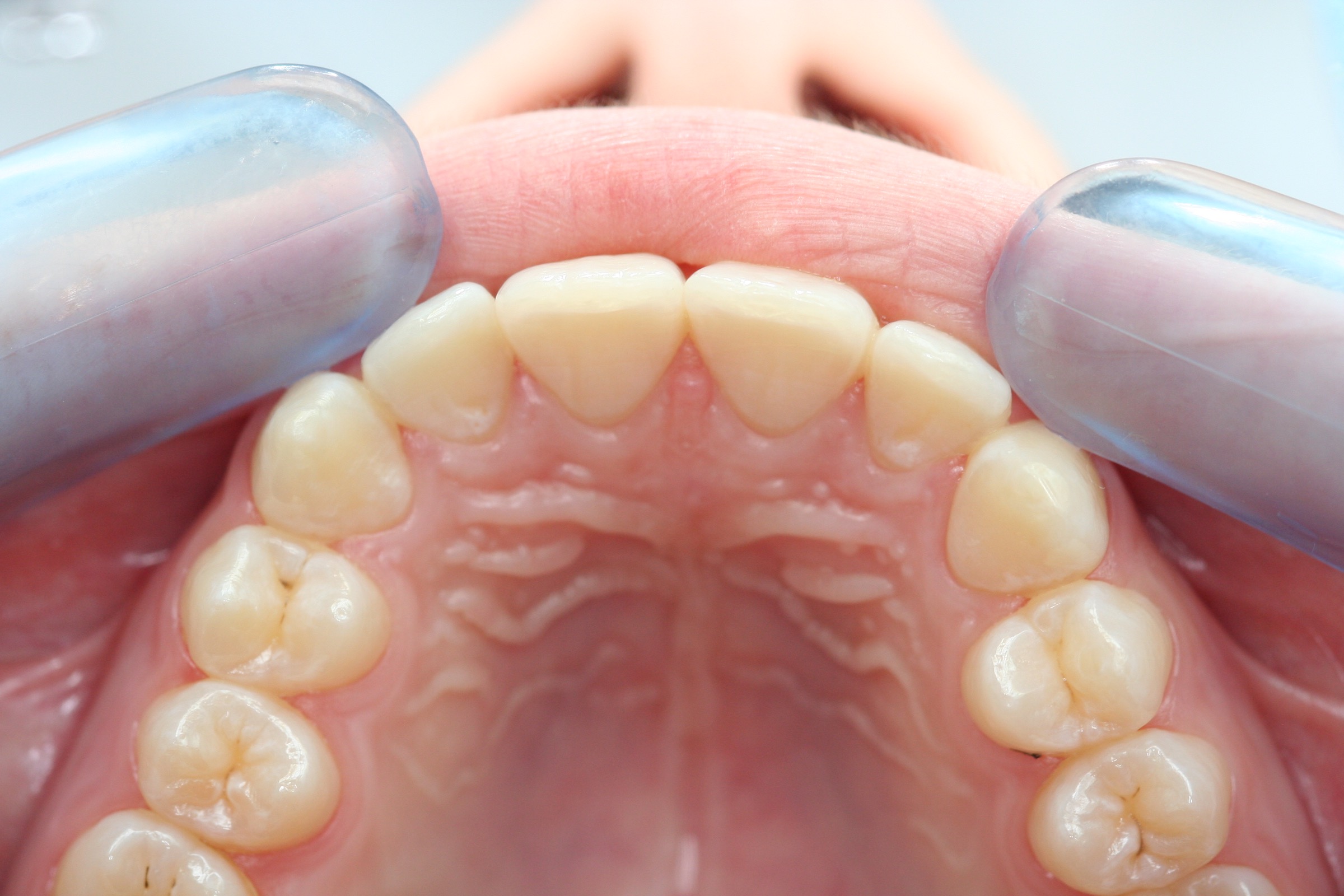 Post-ortho retainer with Dentapreg SFU by Ralf Schönemann, clinical step 05.