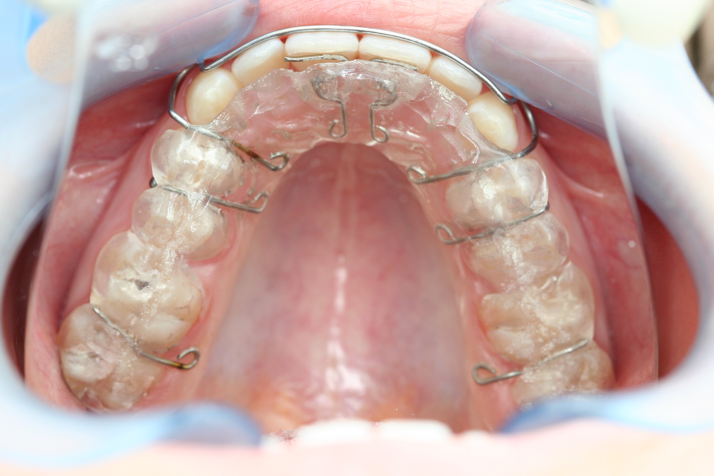 Post-ortho retainer with Dentapreg SFU by Ralf Schönemann, clinical step 08.