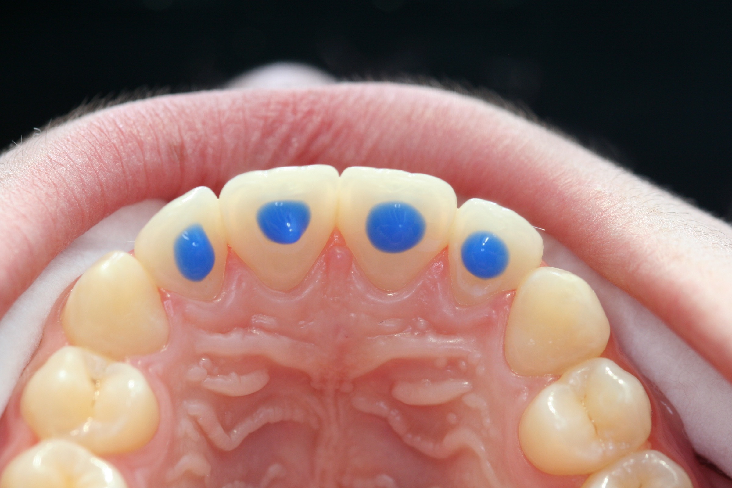 Post-ortho retainer with Dentapreg SFU by Ralf Schönemann, clinical step 12.