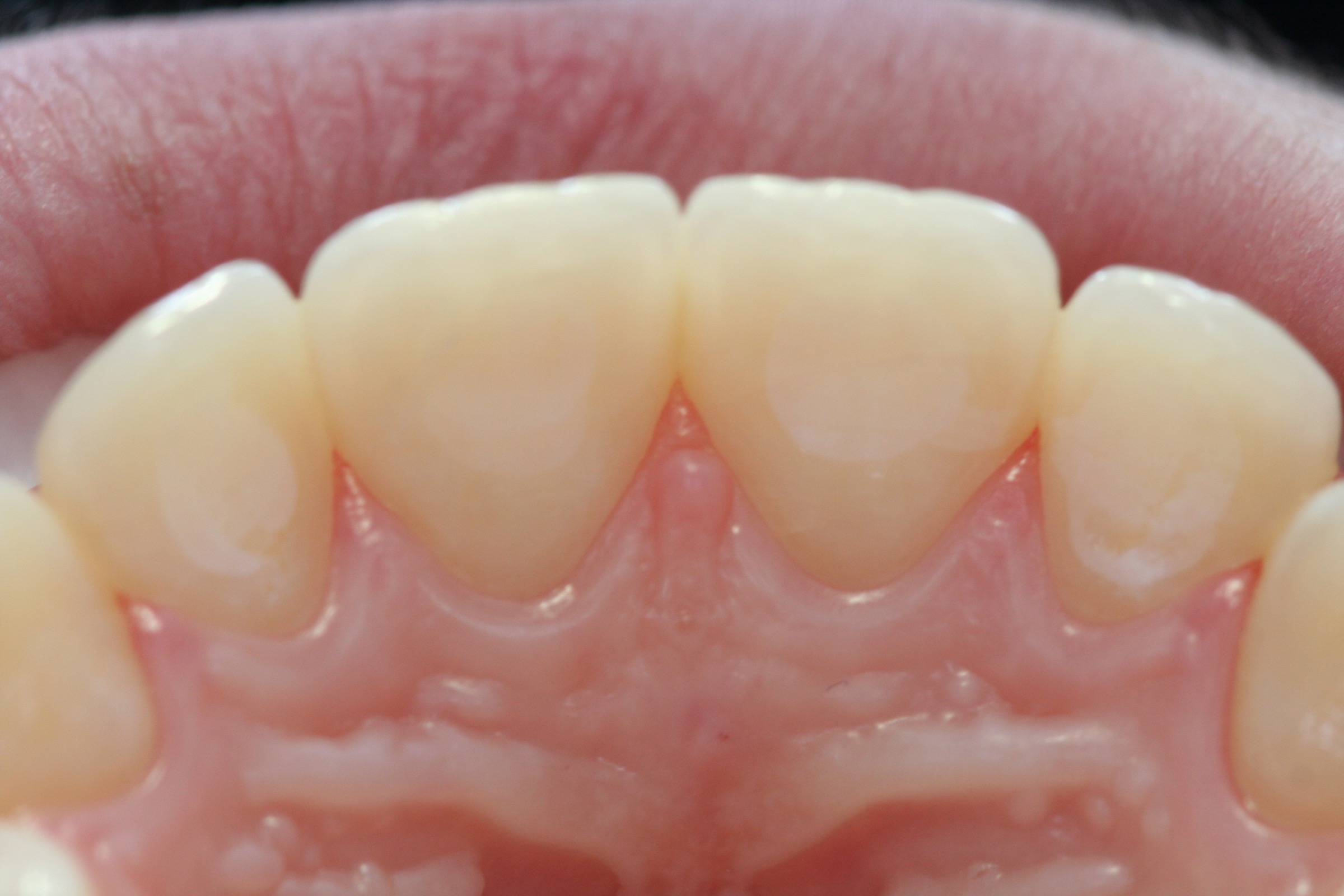 Post-ortho retainer with Dentapreg SFU by Ralf Schönemann, clinical step 15.