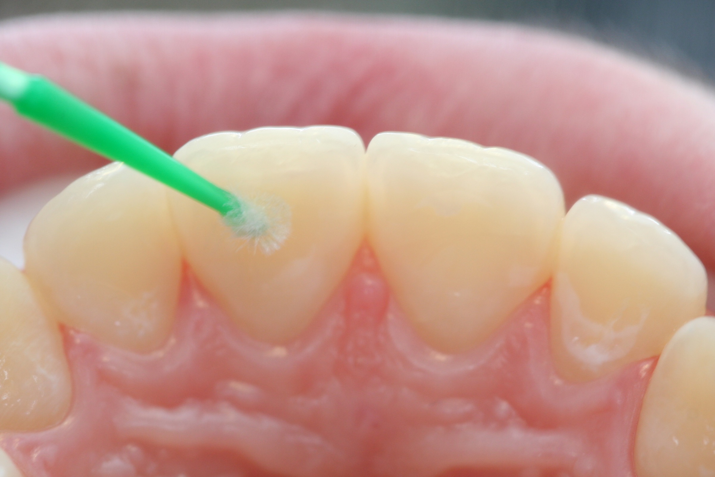 Post-ortho retainer with Dentapreg SFU by Ralf Schönemann, clinical step 17.