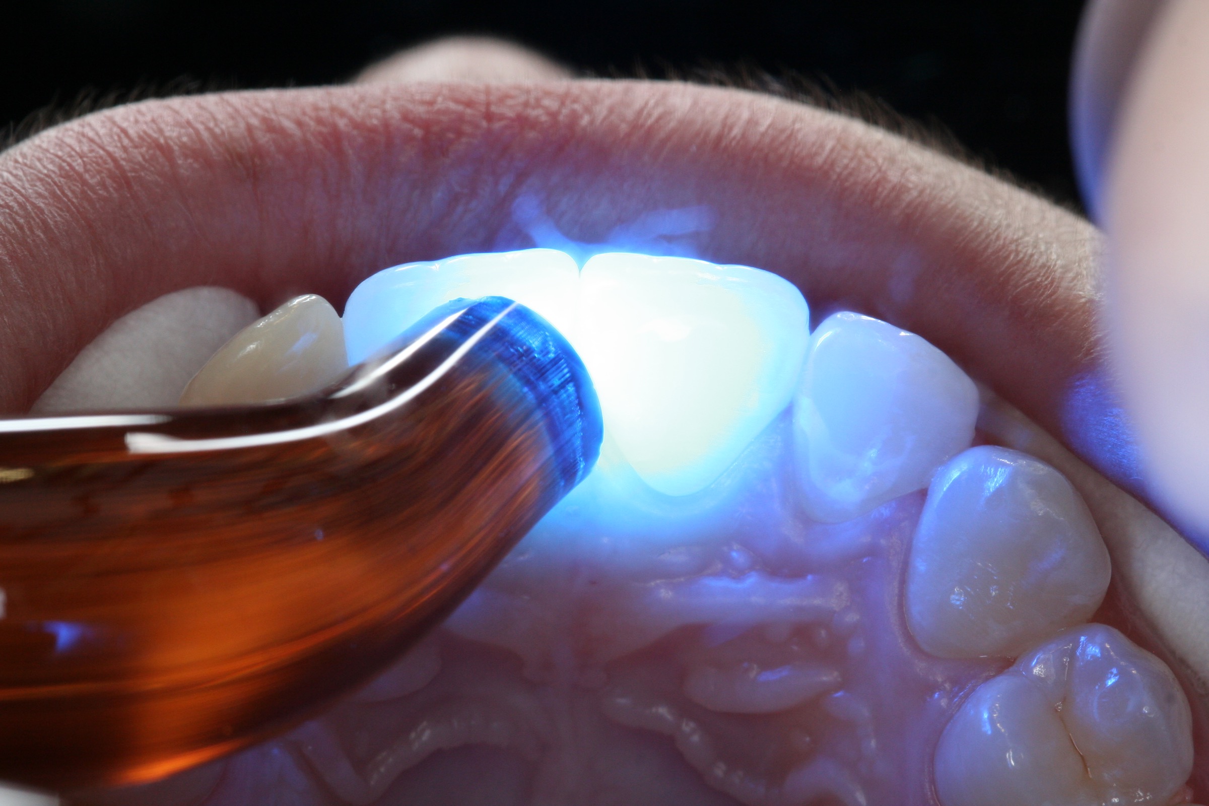 Post-ortho retainer with Dentapreg SFU by Ralf Schönemann, clinical step 20.