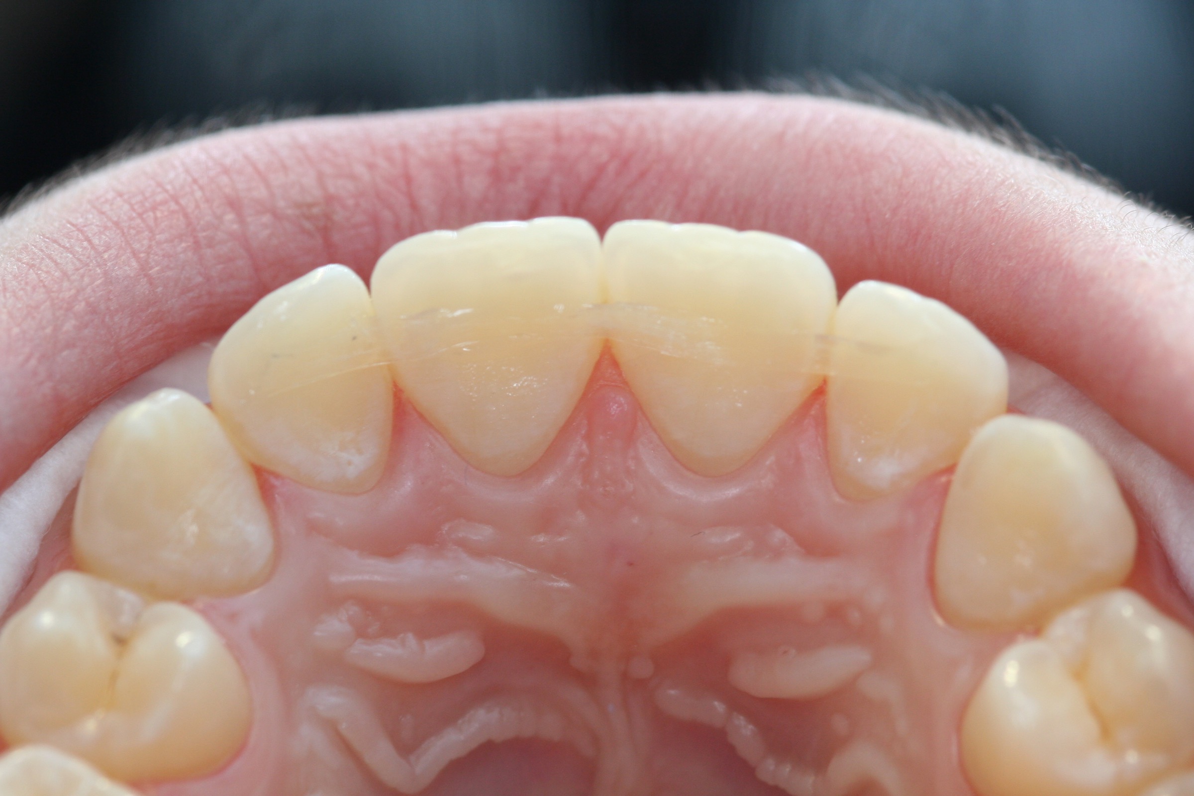 Post-ortho retainer with Dentapreg SFU by Ralf Schönemann, clinical step 21.