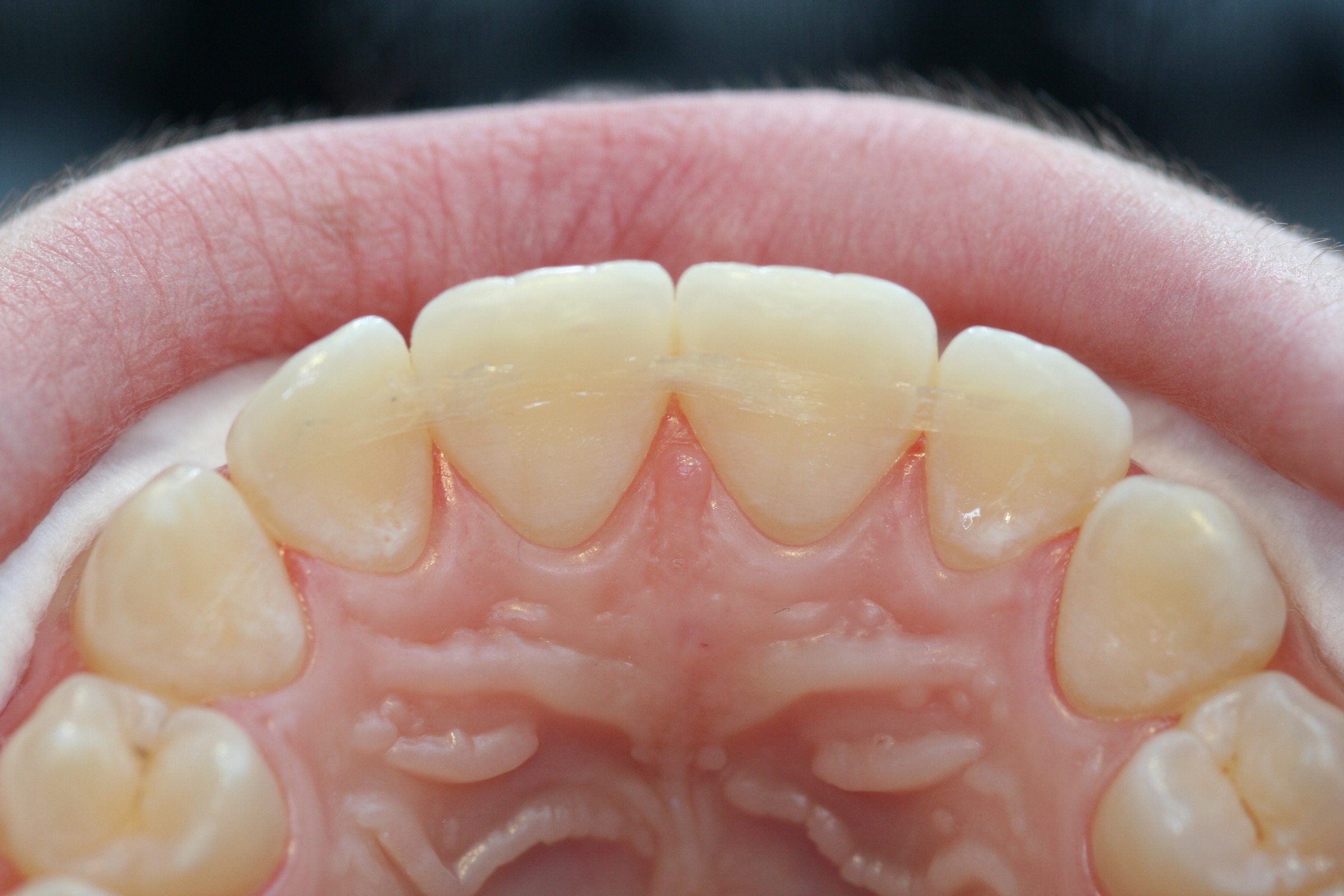 Post-ortho retainer with Dentapreg SFU by Ralf Schönemann, clinical step 23.