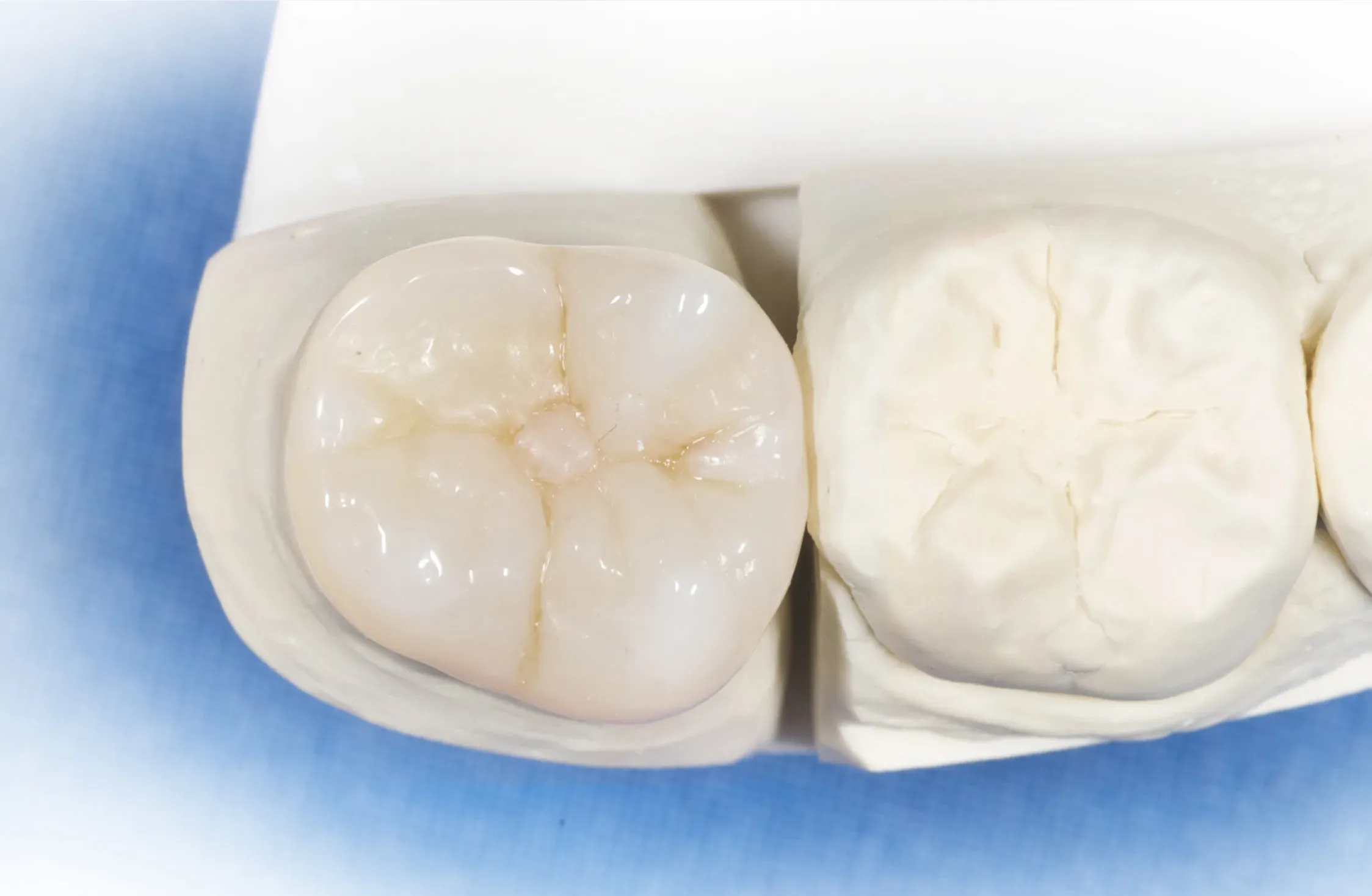 Completed composite crown reinforced with Dentapreg VEIL.