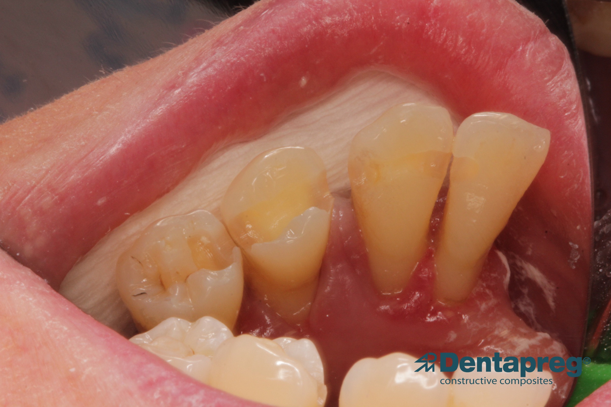 Oral splint with Dentapreg SFU by Agnieszka Pazdzior-Klocek, first step.