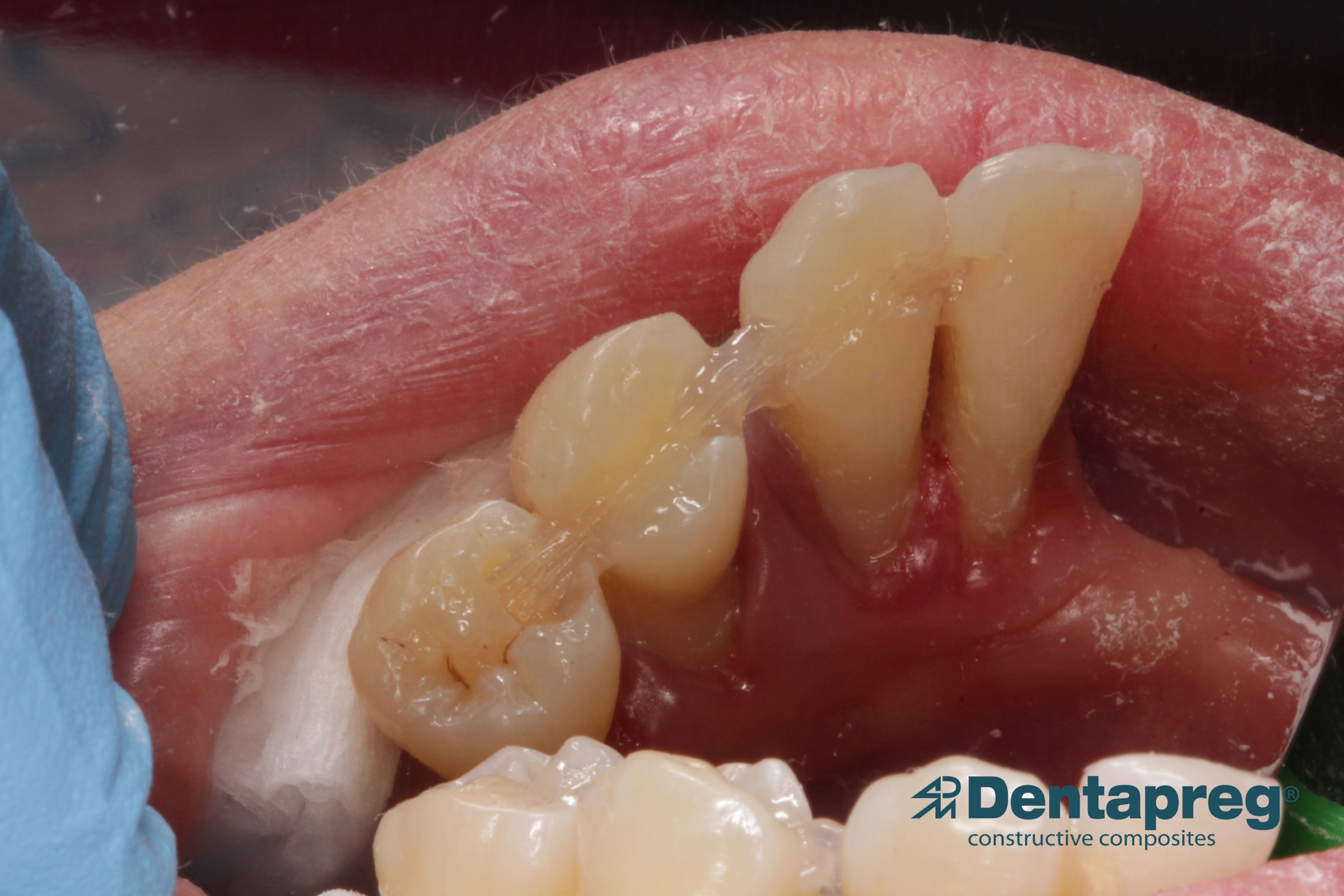 Completed oral splint with Dentapreg SFU by Agnieszka Pazdzior-Klocek.
