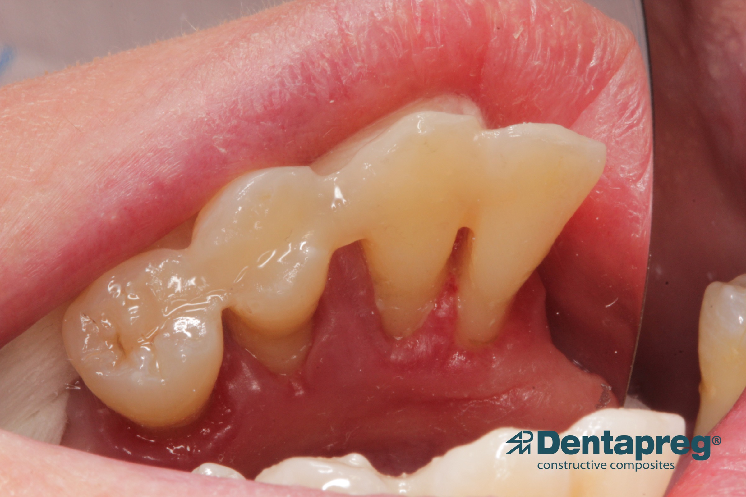 Oral splint with Dentapreg SFU by Agnieszka Pazdzior-Klocek, second step.