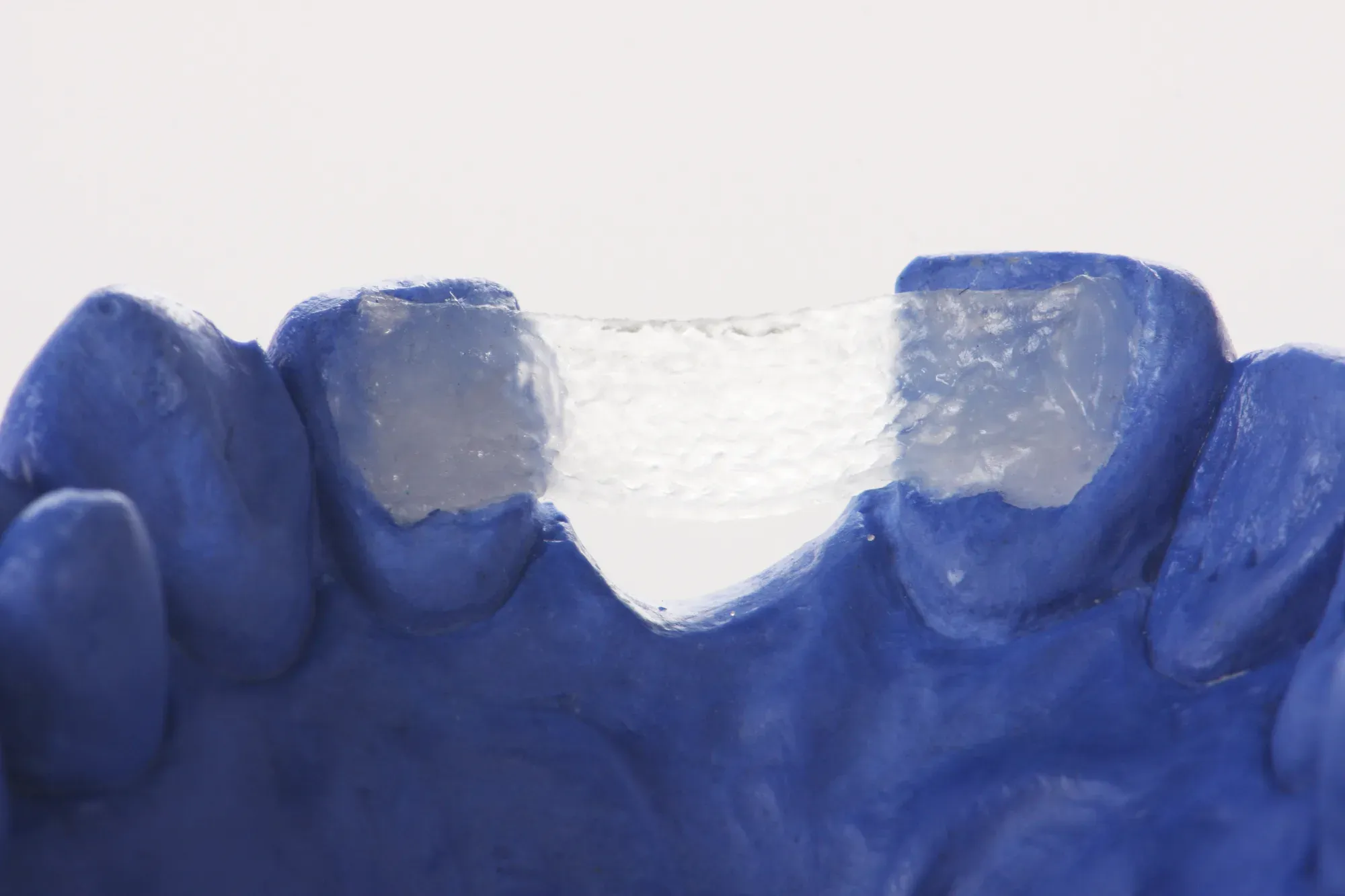 Dentapreg® BRAID placed on blue dental model for stabilization.