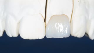 Dentapreg® BRAID used in dental bridge construction on tooth model.