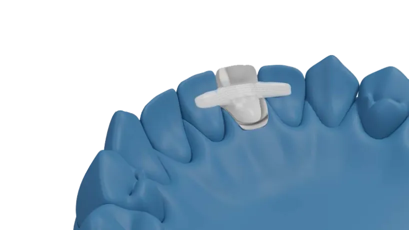 Dentapreg® BRAID applied to tooth model with rubber dam isolation.