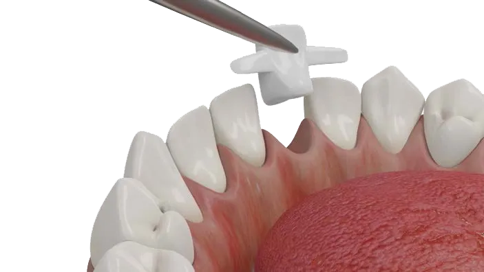 Dentapreg® BRAID being adjusted on tooth model using dental tool.