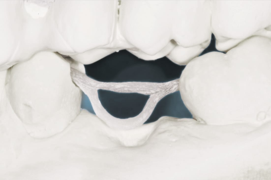 Dentapreg® BUNDLE forming framework for dental bridge on model.