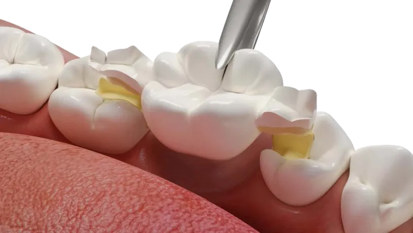 Dentapreg® BUNDLE being adapted on posterior teeth for reinforcement.