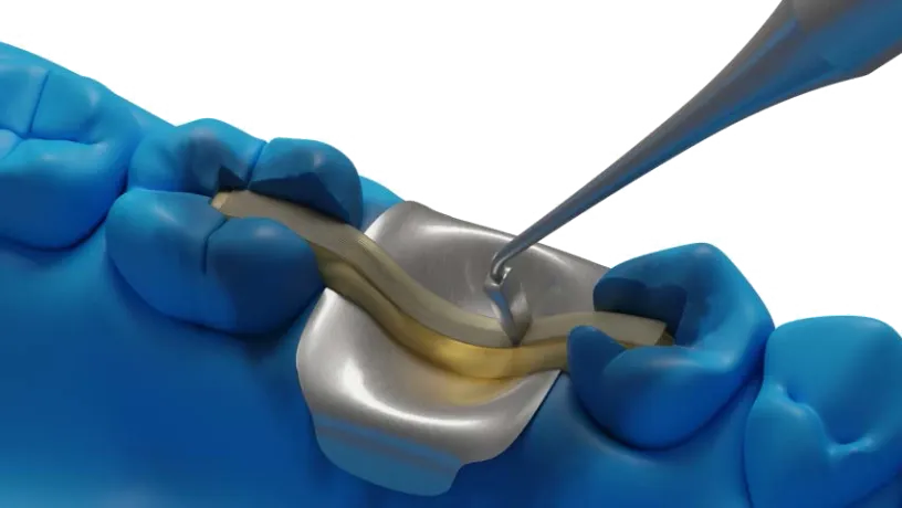 Dentapreg® BUNDLE applied for anterior tooth stabilization on dental model.