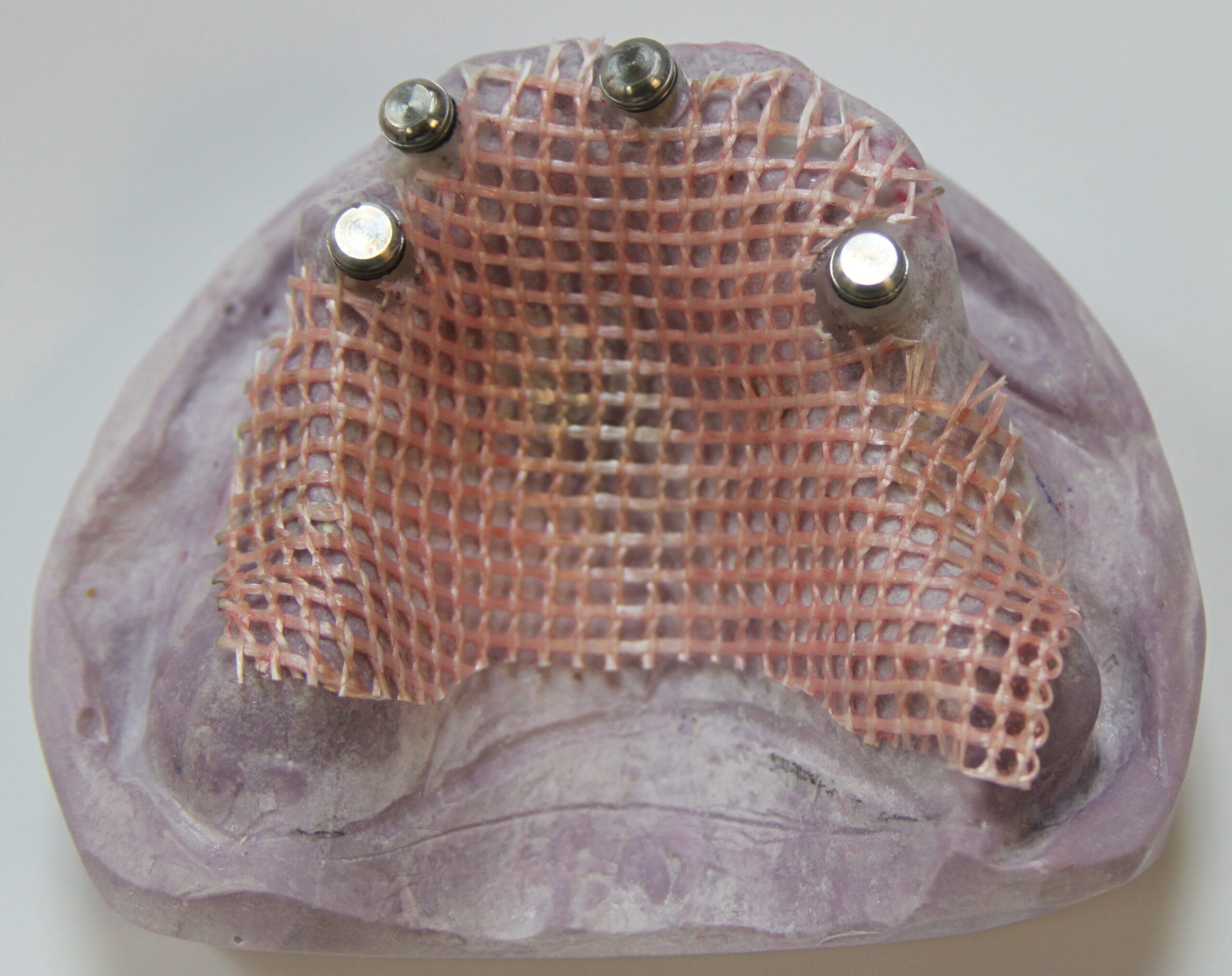 Dentapreg® MESH for implant-supported denture reinforcement and stability.