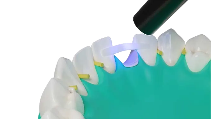 Dentapreg® PFM strip curing process with UV light on a dental model for stability.
