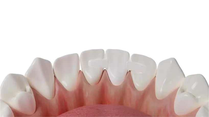Dentapreg® PFM strip applied to front teeth for dental reinforcement and stability.