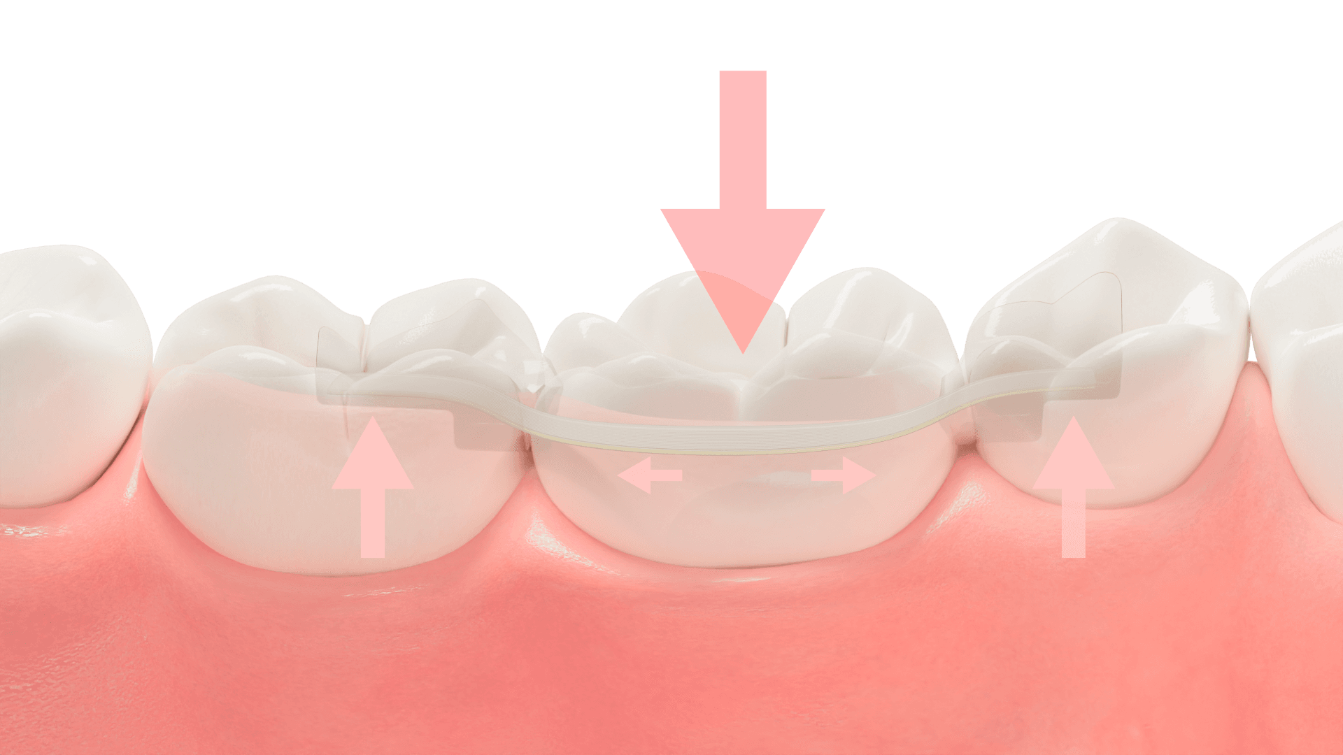 Dentapreg clinical reinforcement
