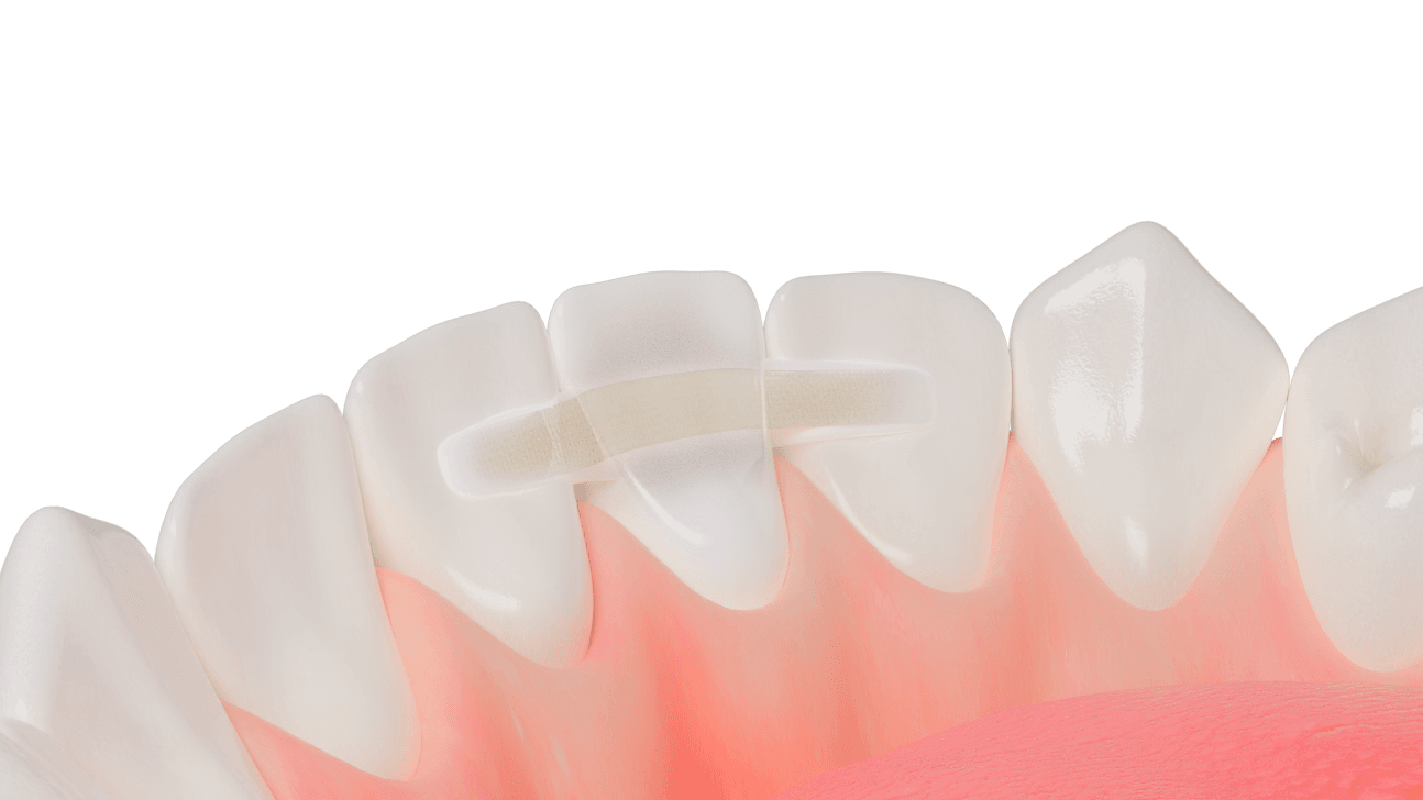 Dentapreg reinforcement principle