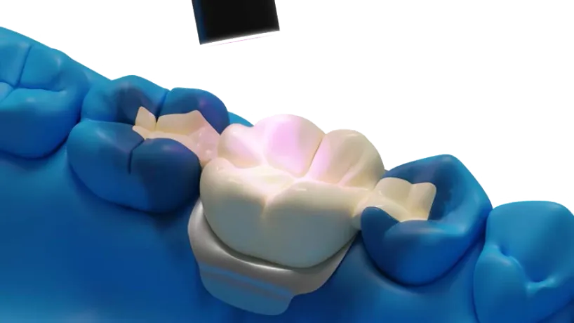 Light curing of composite material over Dentapreg PFU® for a durable dental restoration.