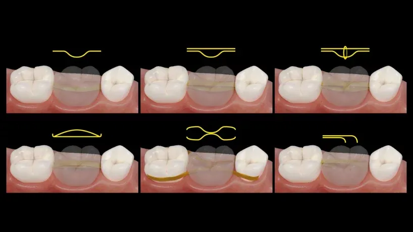 Diagram illustrating the application and positioning of Dentapreg PFU® for optimal dental restoration.