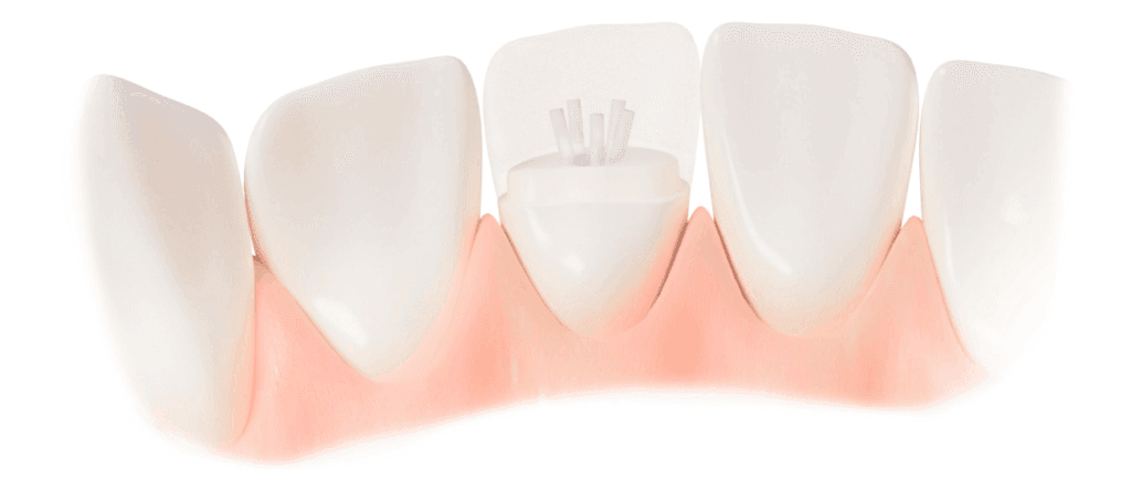 Dentapreg reinforced restoration