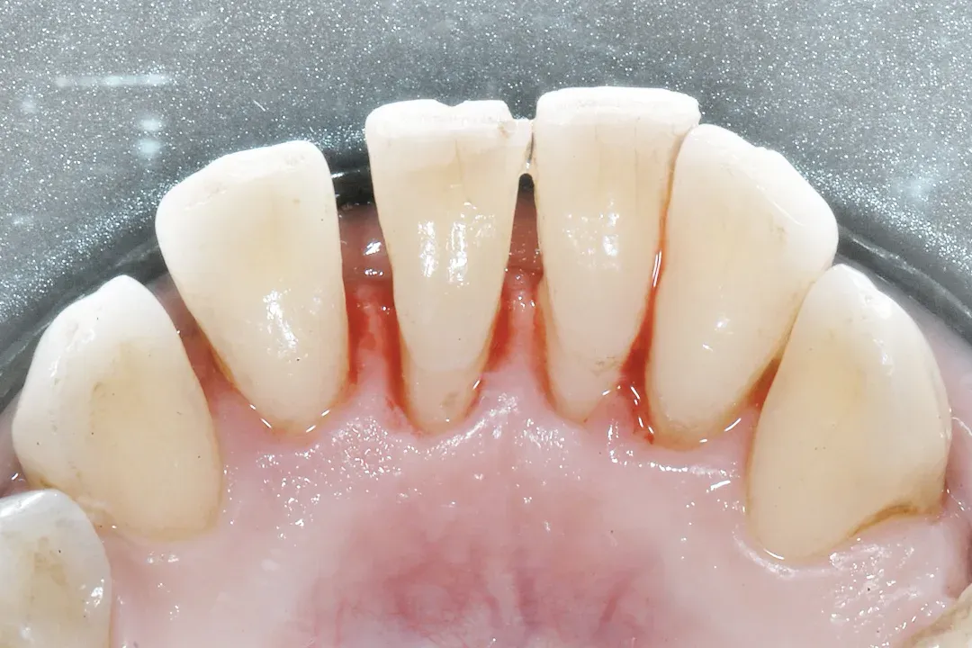 Perio splinting with Dentapreg® fiber strip for durable adhesion and aesthetic stability.
