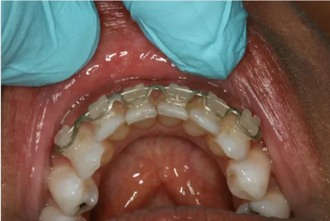 Application of Dentapreg® SFM strip for discreet and secure post-orthodontic retention.