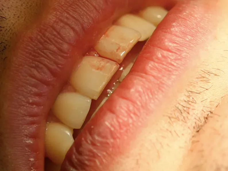 Dentapreg® SFM trauma splint securing a loose tooth with minimal discomfort.