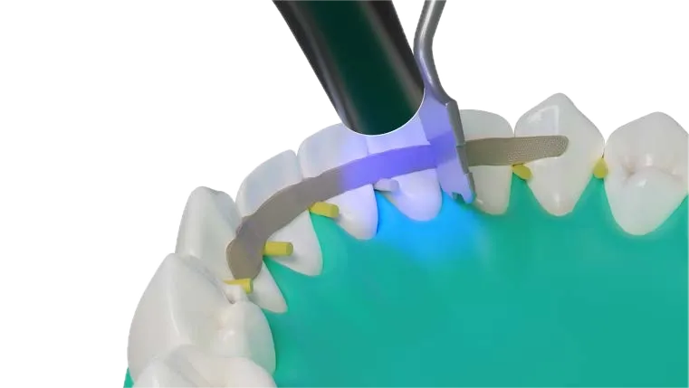 Dental splinting with Dentapreg® SFM strip, light curing in progress with isolation wedges and rubber dam.