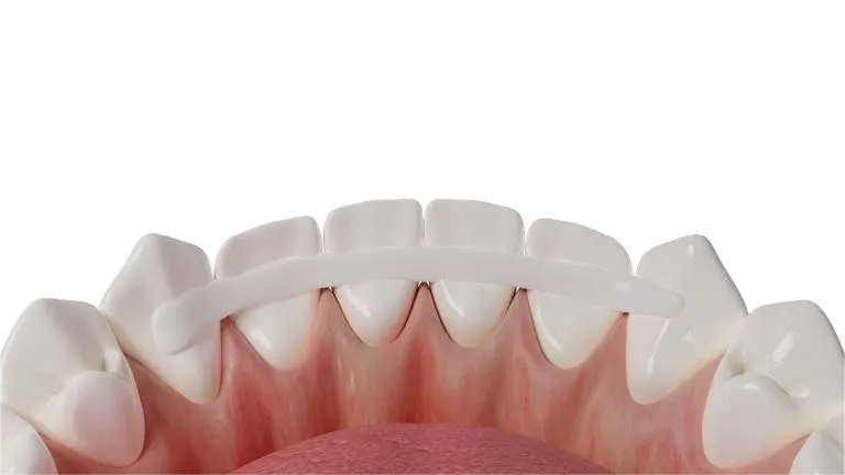 Completed Dentapreg® SFM dental splint on lower front teeth, with a smooth composite finish for stability.
