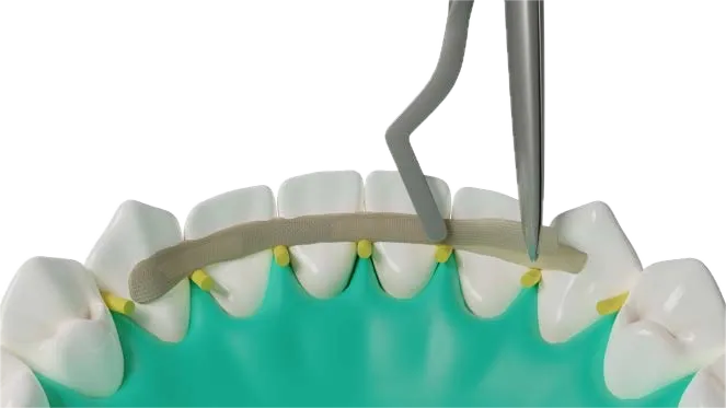 Dentapreg SFM aplication