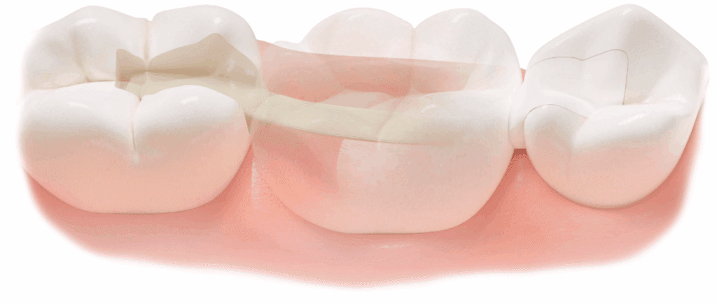 Dentapreg splint and retainer application