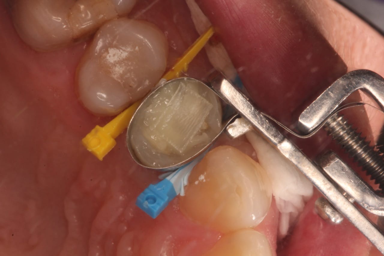 Dentapreg® UFM placed in a sectional matrix for restoration.