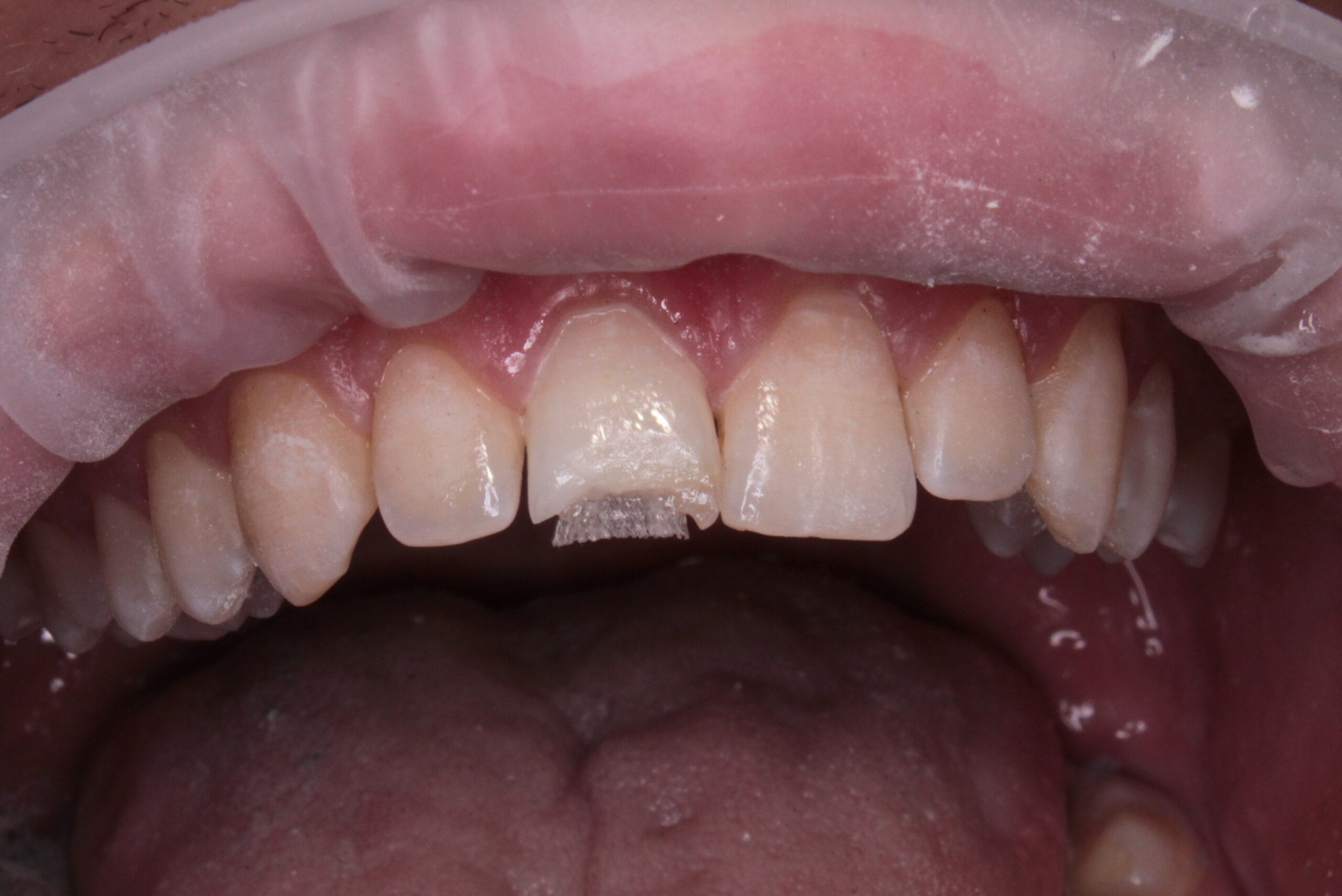Dentapreg® UFM applied for incisor reinforcement.