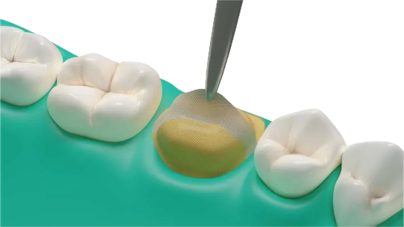 Dentapreg® UFM applied to a molar for dental restoration.