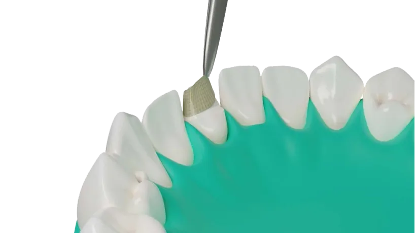 Dentapreg® UFM applied to an incisor for dental restoration.