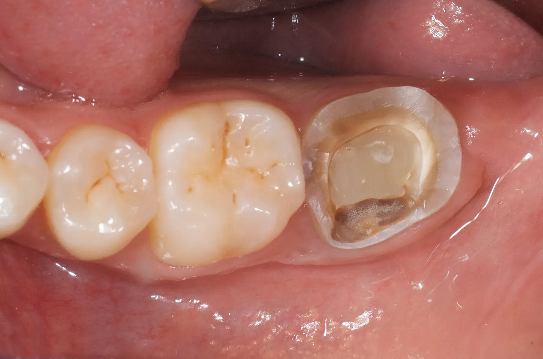 Tooth prepared for onlay restoration with Dentapreg® VEIL, ensuring durable dental reinforcement.