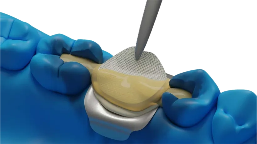 Applying Dentapreg® VEIL to a dental model for tooth reinforcement.
