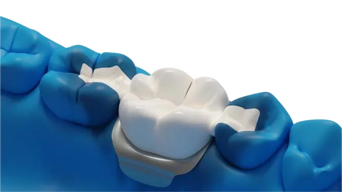 Completed dental restoration reinforced with Dentapreg® VEIL.