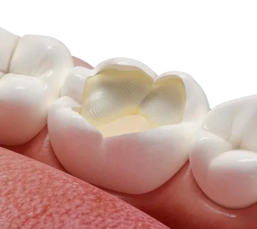Fibrafill® CUBE reinforcing a molar cavity for restoration