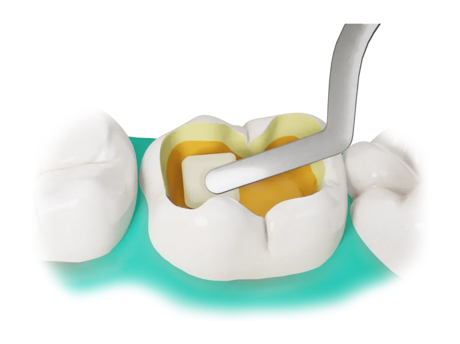 Fibrafill CUBE restoration visualisation