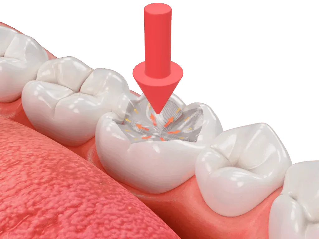 Fibrafill® CUBE protecting vulnerable restoration areas