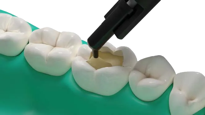 Fibrafill® Dentin composite applied for tooth restoration.