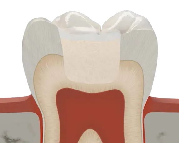 Fibrafill® Dentin composite reinforcing tooth structure in cross-section.